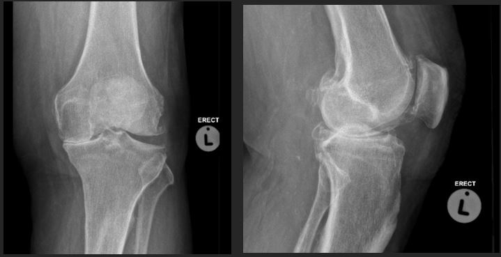 pre-operative-knee-arthritis